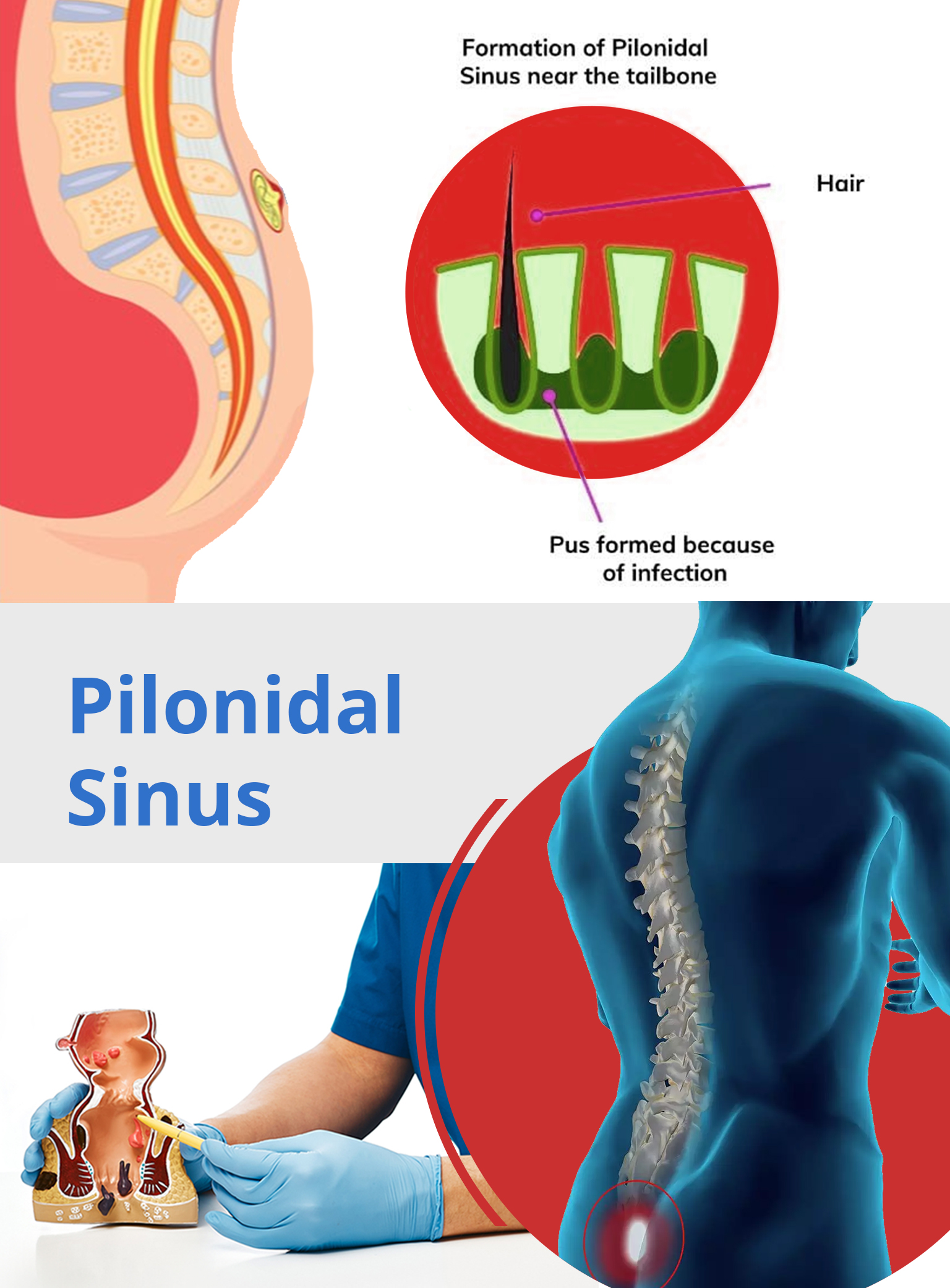 Pilonidal Sinus - Evergreen Surgical Pilonidal Clinic